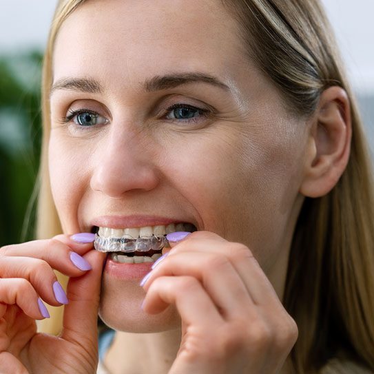 7 Benefits of Clear Aligners - Euclid Dental Center - clear aligners,straight teeth clear aligners straight teeth